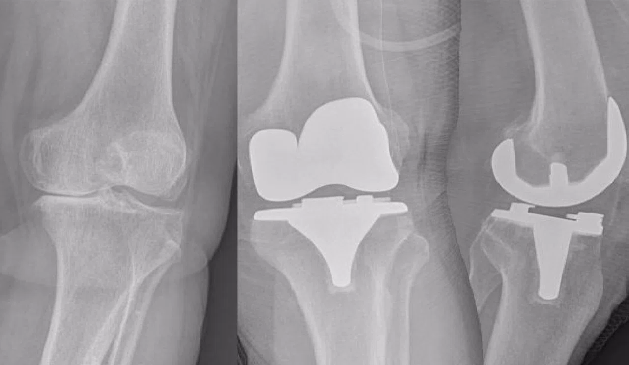 Bunu biliyor musunuz? Bebeklerin diz kapakları röntgen filminde neden görünmez?