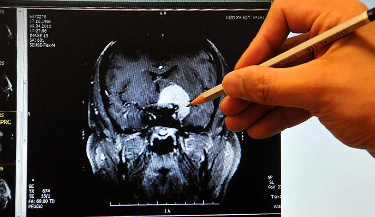 Sizde de bu belirtiler varsa... Pıhtı oluşuyor olabilir.