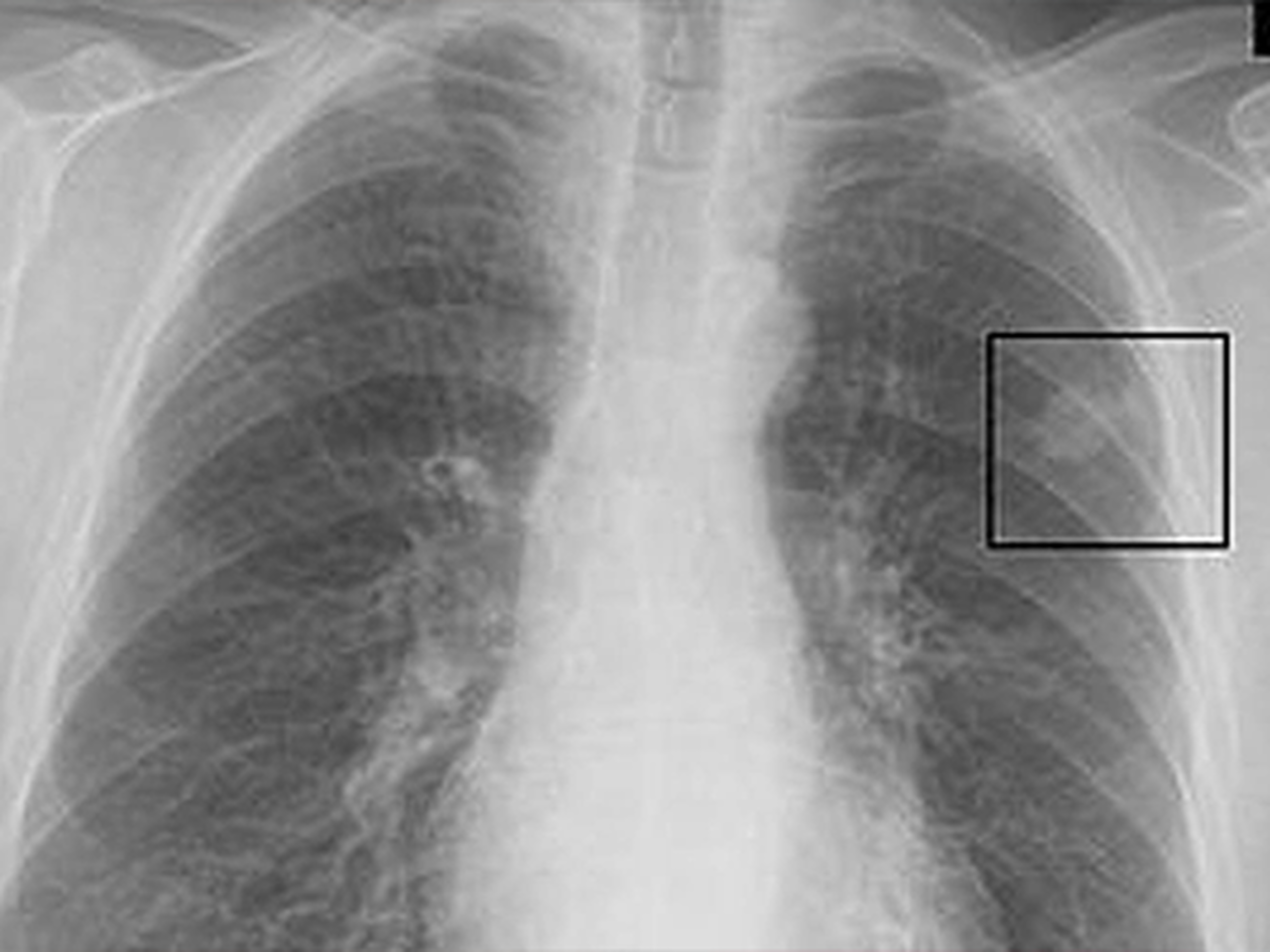 Uzmanından uyarı! “Akciğerimde leke var” diyenler dikkat