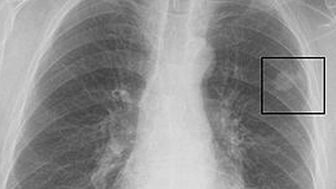 Uzmanından uyarı! “Akciğerimde leke var” diyenler dikkat