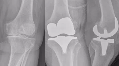 Bunu biliyor musunuz? Bebeklerin diz kapakları röntgen filminde neden görünmez?