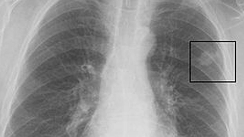 Uzmanından uyarı! “Akciğerimde leke var” diyenler dikkat
